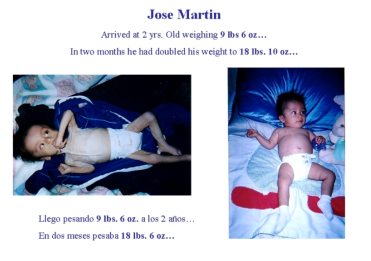 Jose Martin, One of the Many Children Who Benefited From the Nutritional Ward